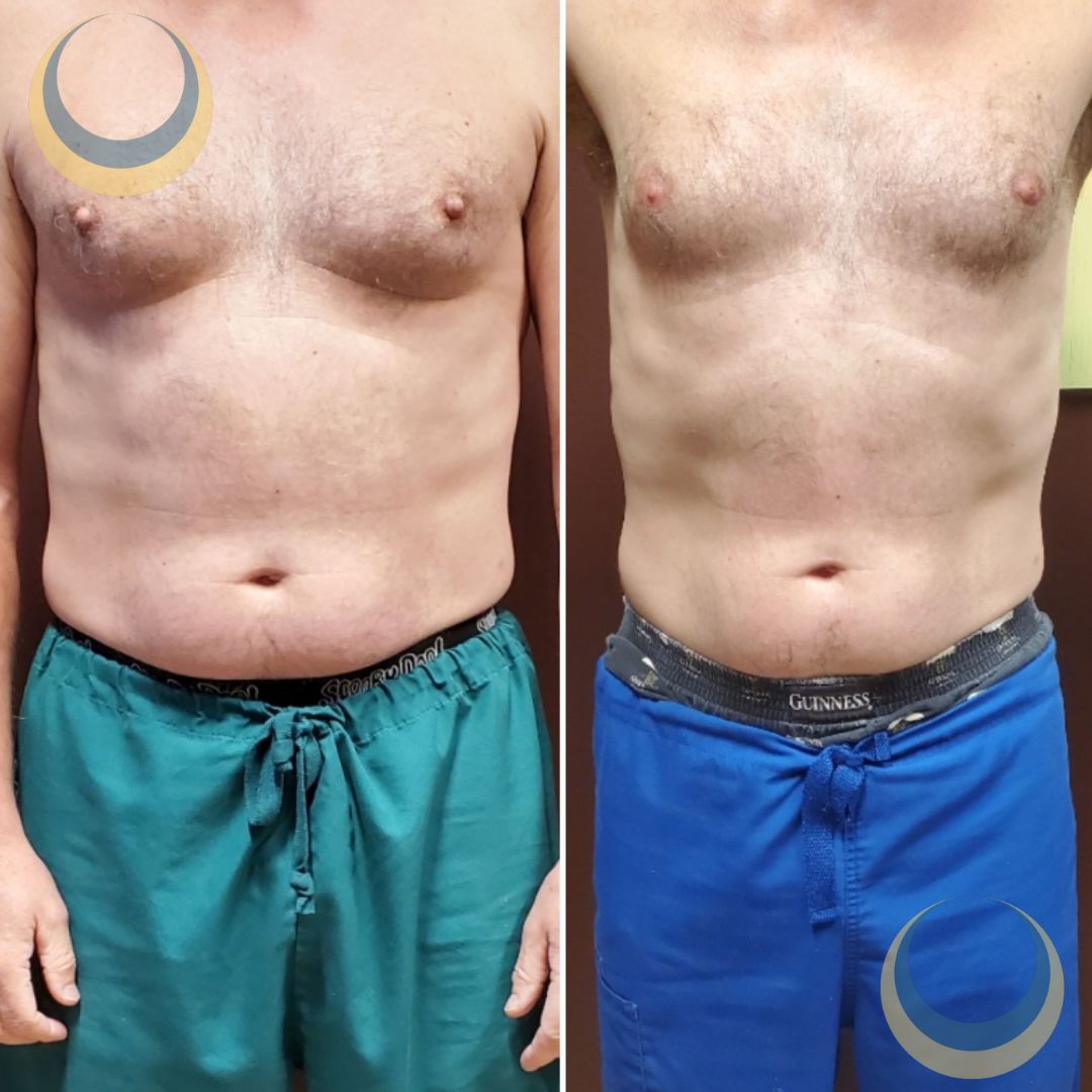 Before and after body sculpting Images | BodySculpt Labs By Sakoon in Omaha NE