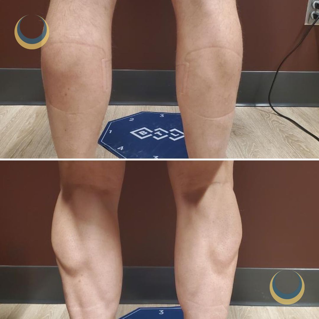 Before and after body sculpting Images | BodySculpt Labs By Sakoon in Omaha NE