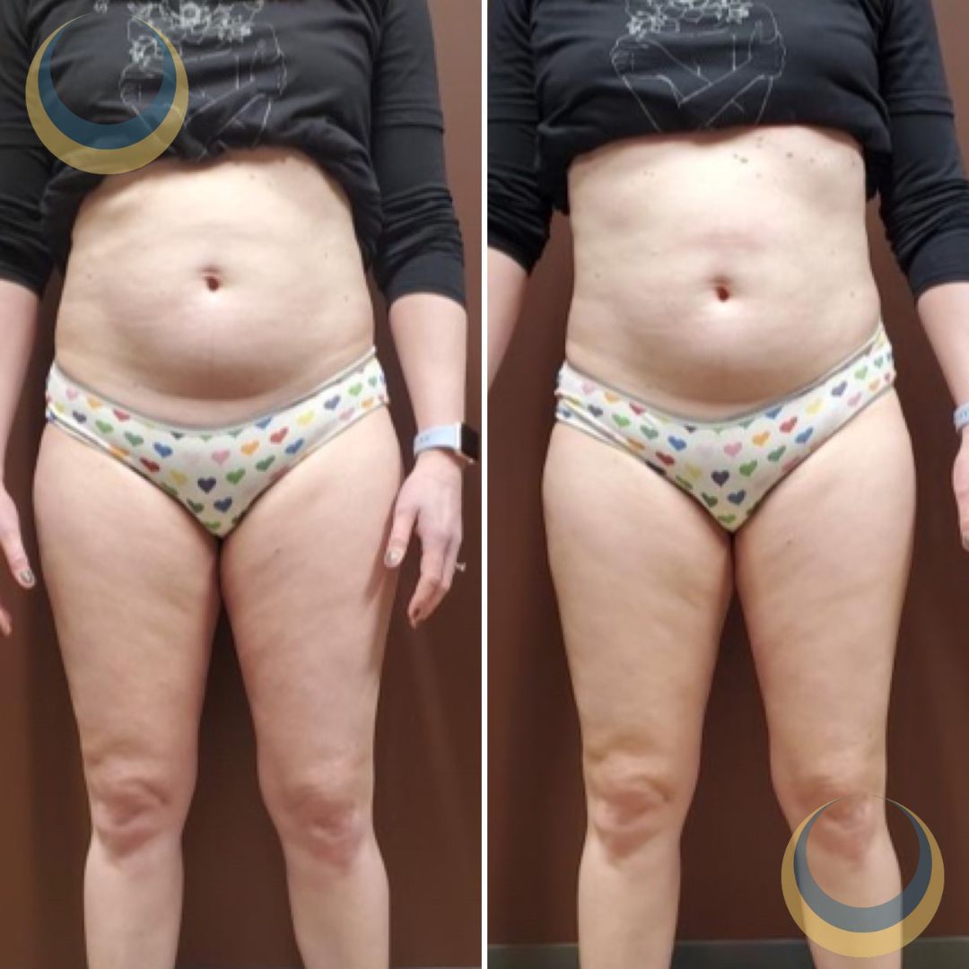 Before and after body sculpting Images | BodySculpt Labs By Sakoon in Omaha NE