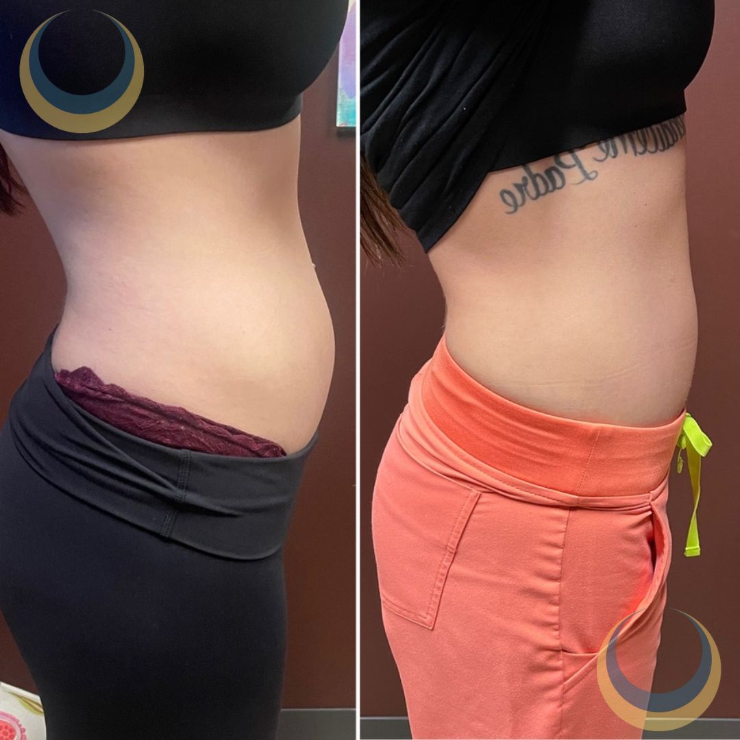 Before and after body sculpting Images | BodySculpt Labs By Sakoon in Omaha NE