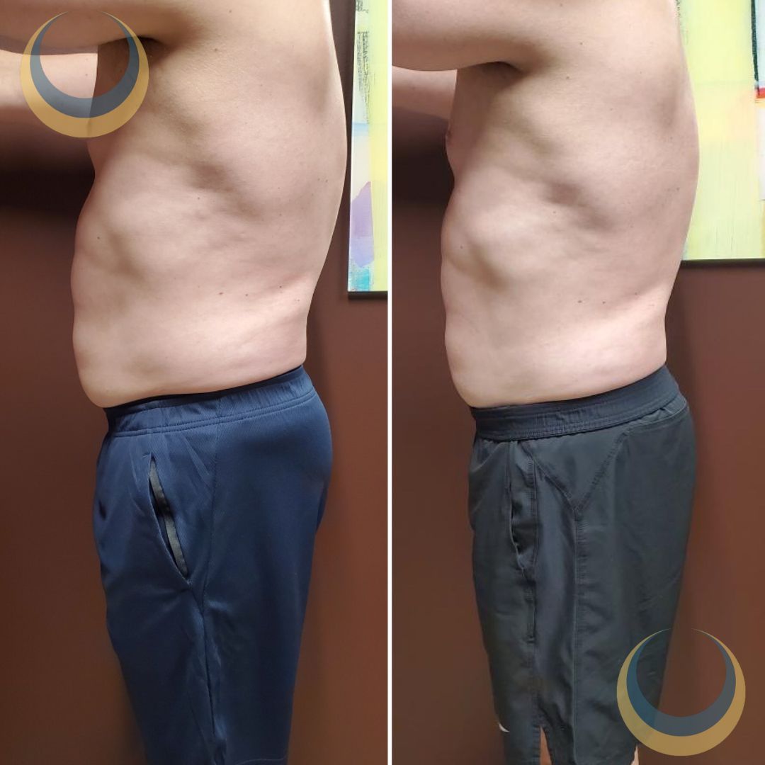 Before and after body sculpting Images | BodySculpt Labs By Sakoon in Omaha NE